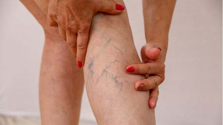 the-aging-circulatory-system-and-varicose-veins:-a-clinical-aromatherapy-approach-|-sixty-and-me